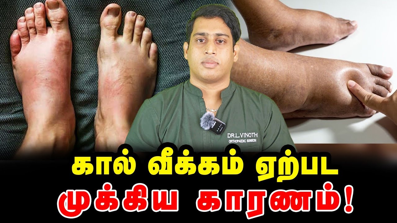 கால்களில் வீக்கம் ஏற்பட முக்கிய காரணம்|Cellulitis symptoms|Cellulitis Treatment|Pedal Edema causes