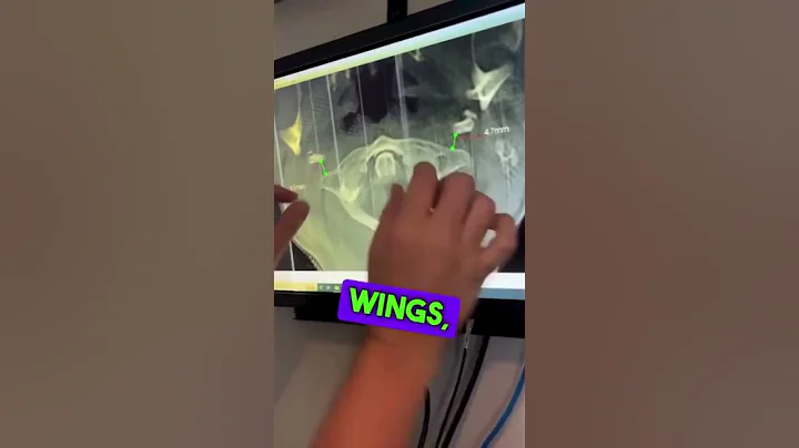 Concussion symptoms? What may cause them? #migraine #headaches #brainfog #dizziness #shorts