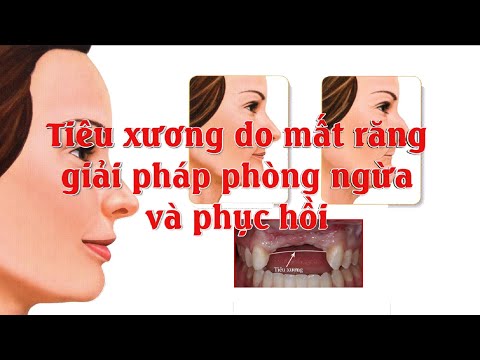 Tiêu xương do mất răng lâu năm - giải pháp phòng ngừa và phục hồi | Trồng răng implant toàn hàm