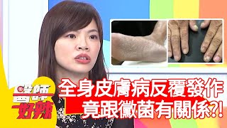 全身皮膚病反覆發作竟跟黴菌有關係【#醫師好辣】20201221 part2 EP1070 陳保仁 宋明樺