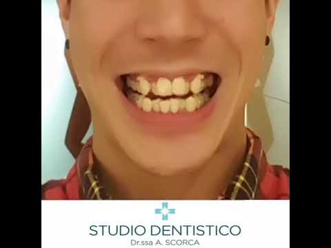 Video: L'apparecchio ortodontico può riparare i denti affollati?