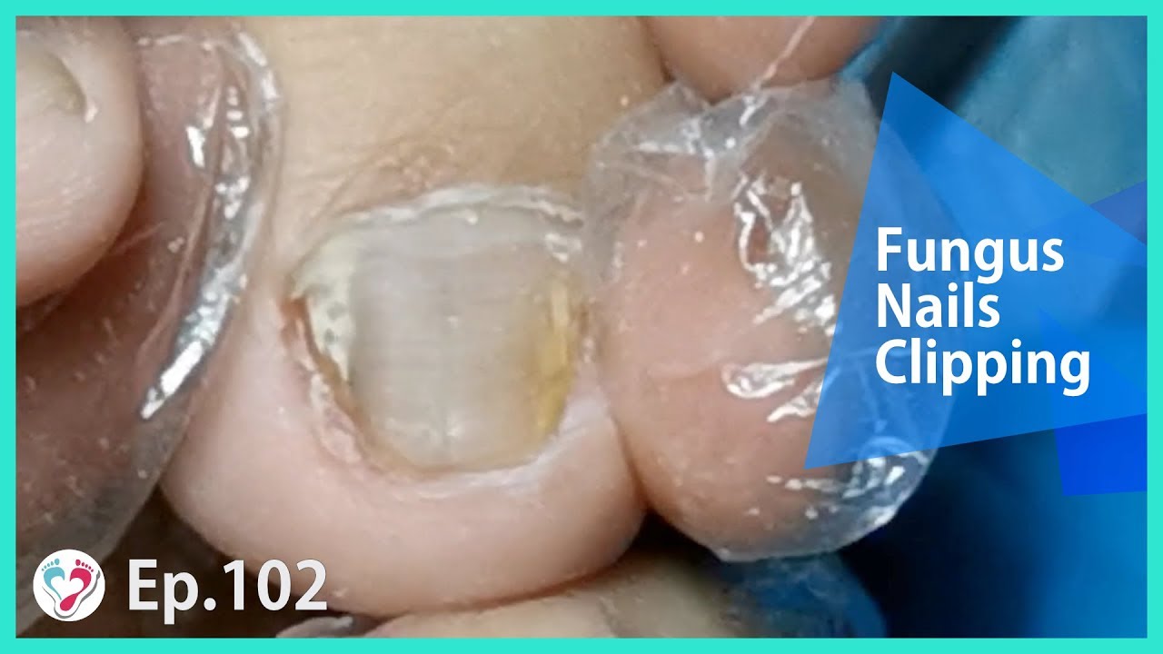 TOP MEDICAL PEDICURE Ep.102 Cure Fungus Toenails The Final Step YouTube
