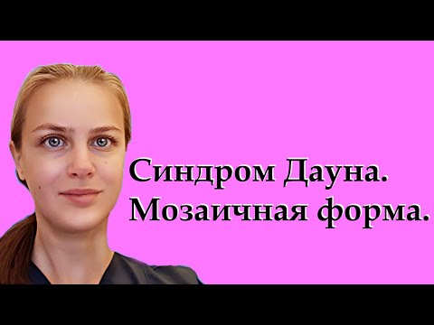 Синдром Дауна. Мозаичная форма. Кариотип. Признаки. Особенности.