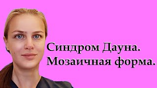 Синдром Дауна. Мозаичная форма. Кариотип. Признаки. Особенности.