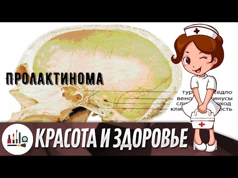 Пролактинома
