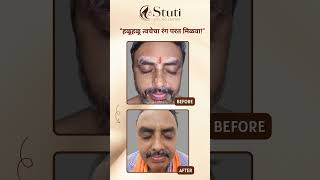 पांढरे डाग वाढतायत? आत्मविश्वास कमी होतोय का ? #vitiligotreatment #पांढरेडाग #shorts #vitiligo #fyp
