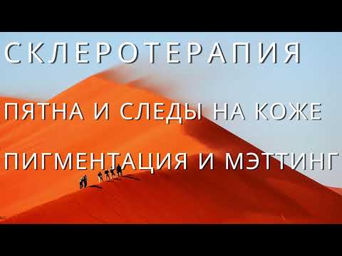 Склеротерапия  вен, сосудистых звездочек. Пятна и Следы на коже Пигментация и Мэттинг  Как бороться?