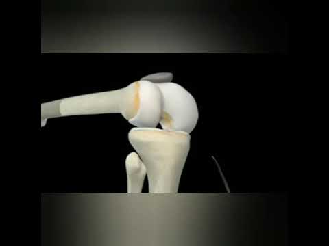 Video: 3 Cara Mengobati Robekan Anterior Cruciate Ligament (ACL)