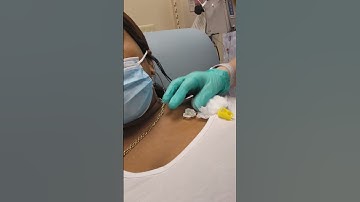 port access #chemolife #follow #grandma #cancer #us #viral #cancercenter