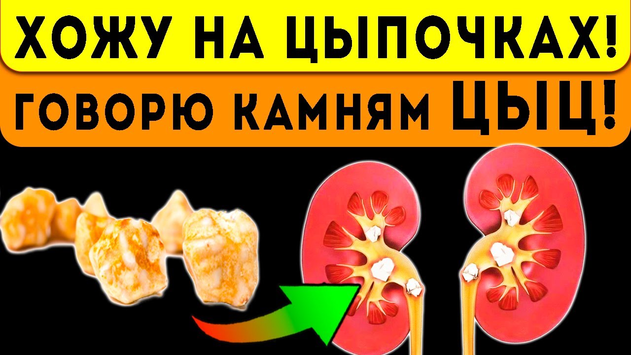 что вызывает выход камня из почек