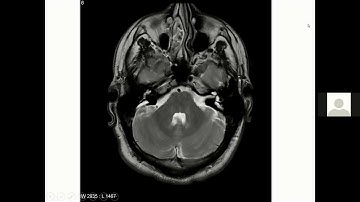 BAPO Webinar 3 Cochlear Implantation