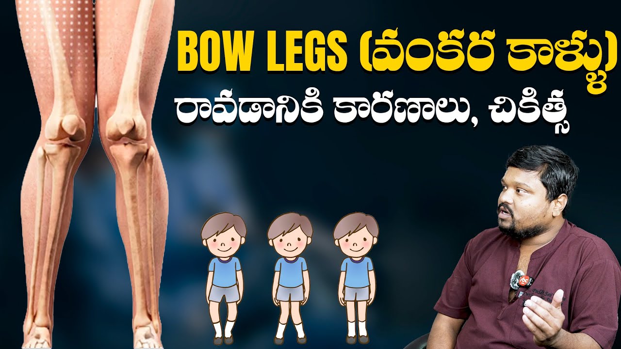 Bowed Legs in Babies - Causes & Treatment | Dr. Peddi Sai Kiran, Orthopaedic Surgeon