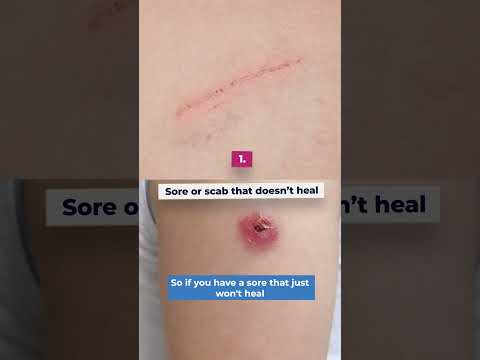 Skin cancer signs that are NOT moles | Ask the dermatologist