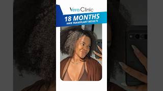 Women Hair Transplant Result 2800 Grafts Female Hair Transplant Before And After