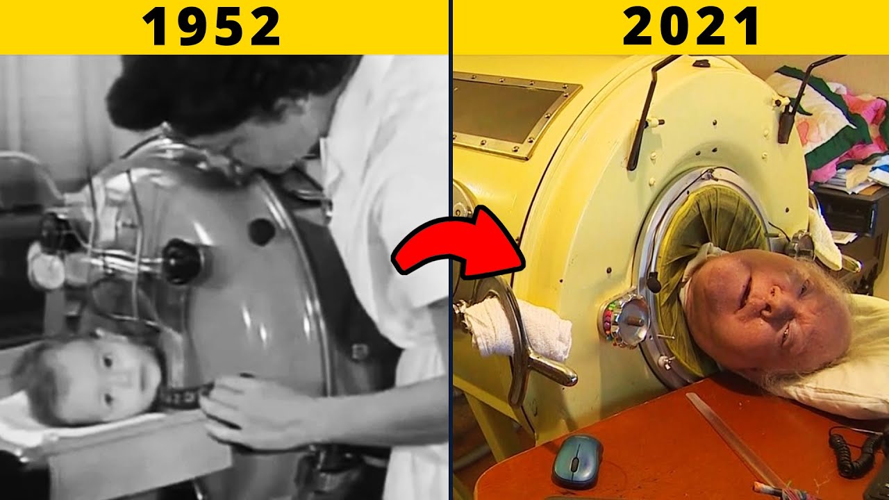 ⁣The Man In The Iron Lung |  Man Locked In This Machine For Almost 70 Years