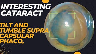 Case series 56. Interesting cataract, tilt and tumble, supra capsular phaco, temporal topical phaco