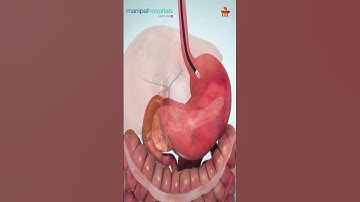 ERCP Procedure Explained | Dr. Pratap Bahera | MBO