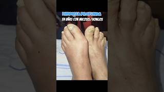 ANTES/DESPUÉS de limpieza profunda en #uñas con micosis/hongos