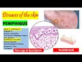 Pemphigus Vulgaris |Pathogenesis, clinical features, oral manifestations | Pemphigus Variants PART 1