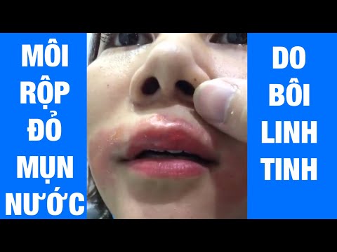 Xăm Môi, Phun Môi Và Cái Kết : Môi Sưng Tấy Đỏ Kèm Mụn Nước Do Bôi Kem Nghệ