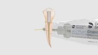 Single Cone Technique with AH Plus® Ribbon Endodontic Sealer and Conform Fit® Gutta-Percha Points