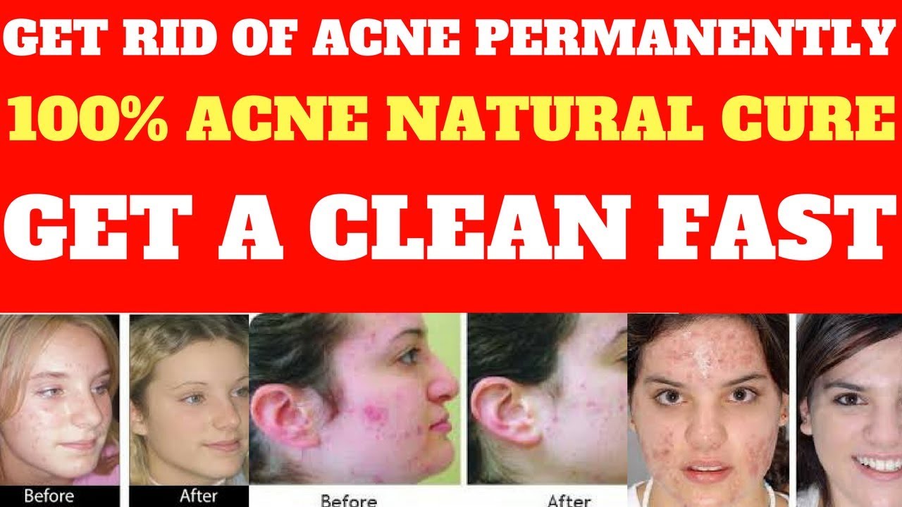 Acne No More PDF Program Reviews-Acne No More Secrets Revealed Series-Acne No More Book Amazon