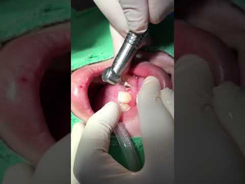 soft tissue trimming bur to remove the surrounding gingival gently