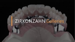 Restoration design with MUAs on unfavourably placed implants | Zirkonzahn.Galleries