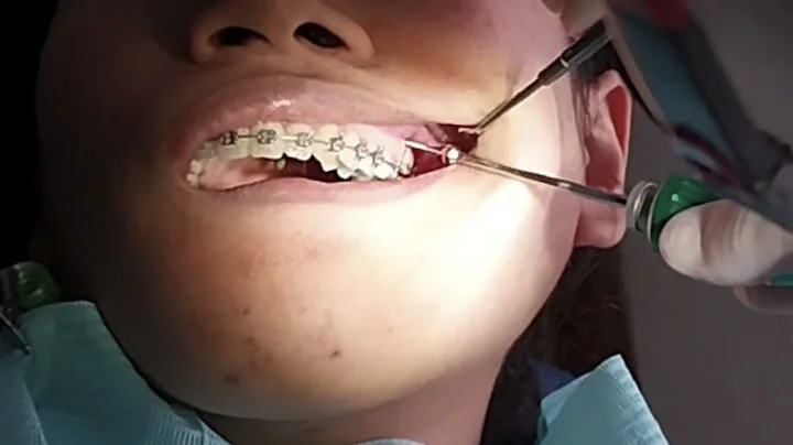 IZC screw, Infra Zygomatic Crest TAD, insertion of IZE mini screw, IZC orthodontic mini implant