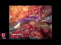 Robotic Radical Antegrade Modular Pancreatosplenectomy (RAMPS)