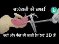 बच्चेदानी की सफाई कब, क्यों और कैसे की जाती है? 3D में - Dilation and Curettage (D & C) in Hindi