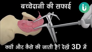 बच्चेदानी की सफाई कब, क्यों और कैसे की जाती है? 3D में - Dilation and Curettage (D & C) in Hindi