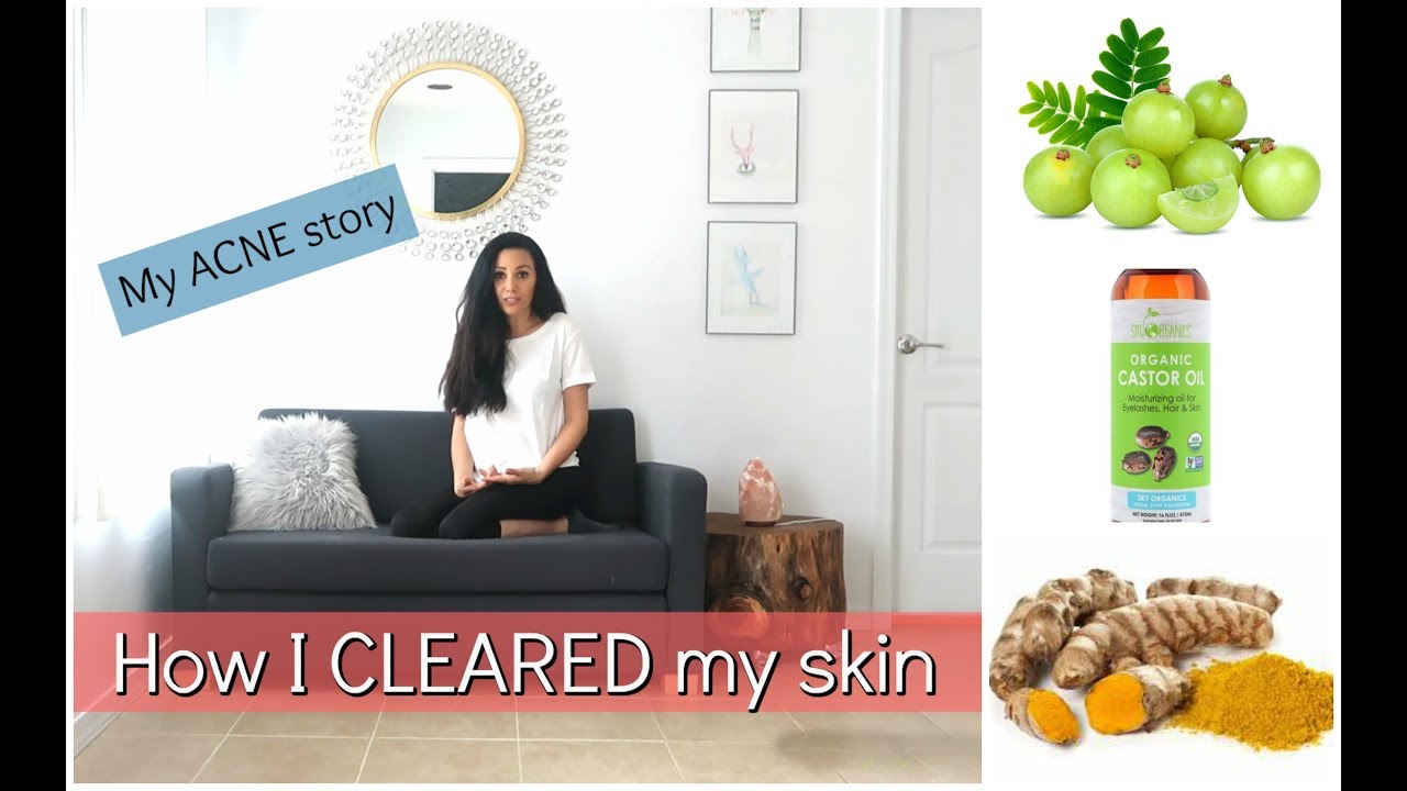 My ACNE story - How I CLEARED my skin -Story time - YouTube