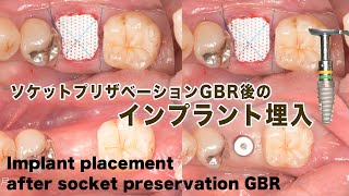 GBRの歯科インプラントへの応用 Amazon.co.jp: GBRの歯科インプラントへの応用 : Japanese Books