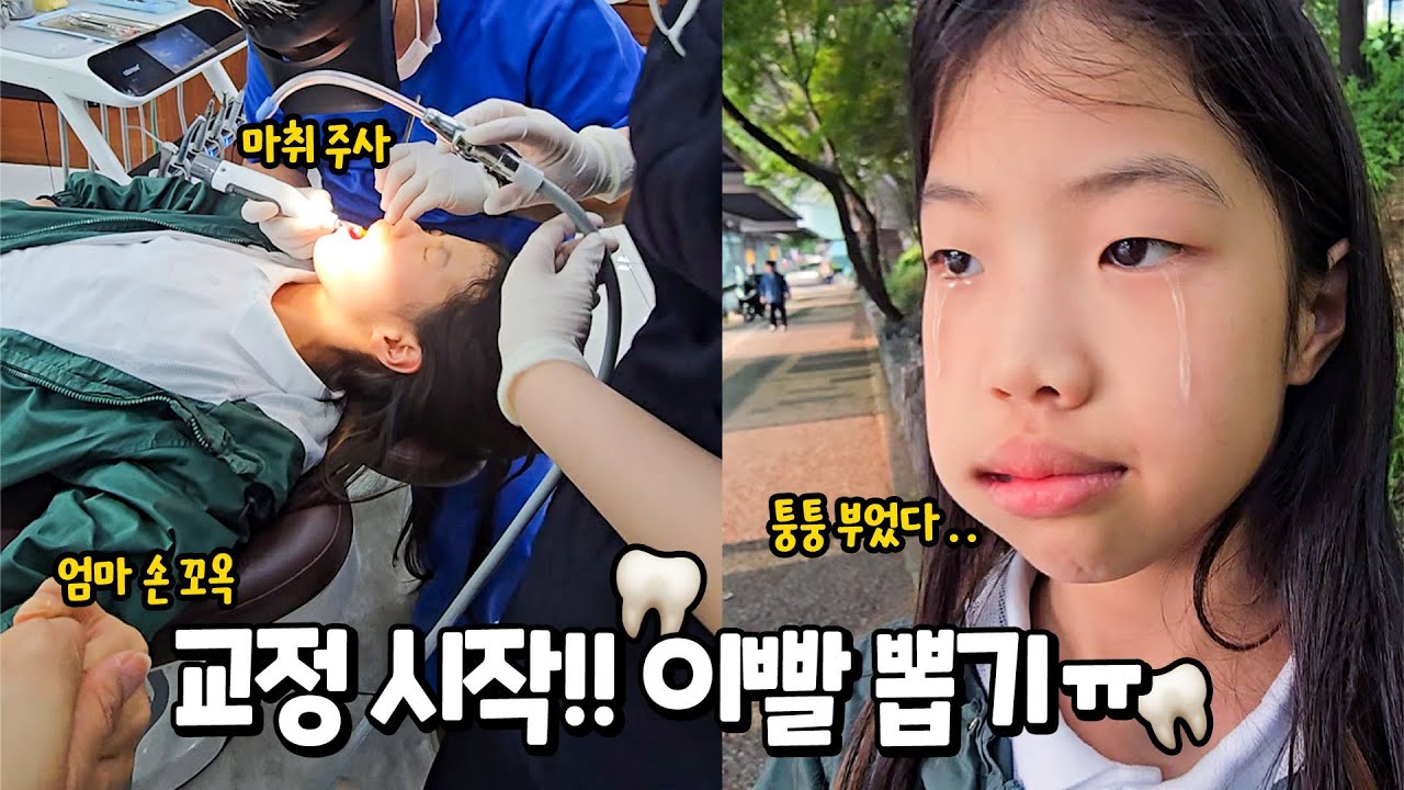 심신이 약하신 분은 시청하지 말아주세요 !! 드디어 교정 시작 전 '생니' 발치 이빨 뽑기 !! 교정 브이로그 가족 일상 별난가족