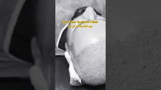 After hair transplant #hair #growhairaestheticclinic#hairtranspnt#hair #afterbefore #chinesemethod