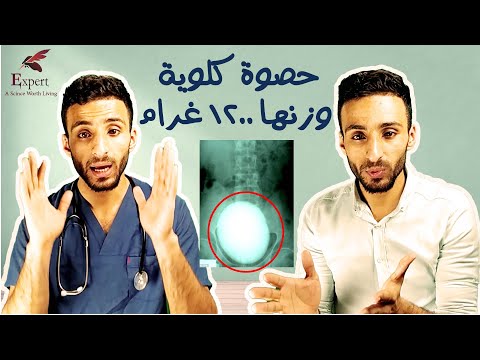 حصوات الكلية اصعب من الم الولادة كيف تتكون وما طرق الوقاية والعلاج علم يستحق الحياة