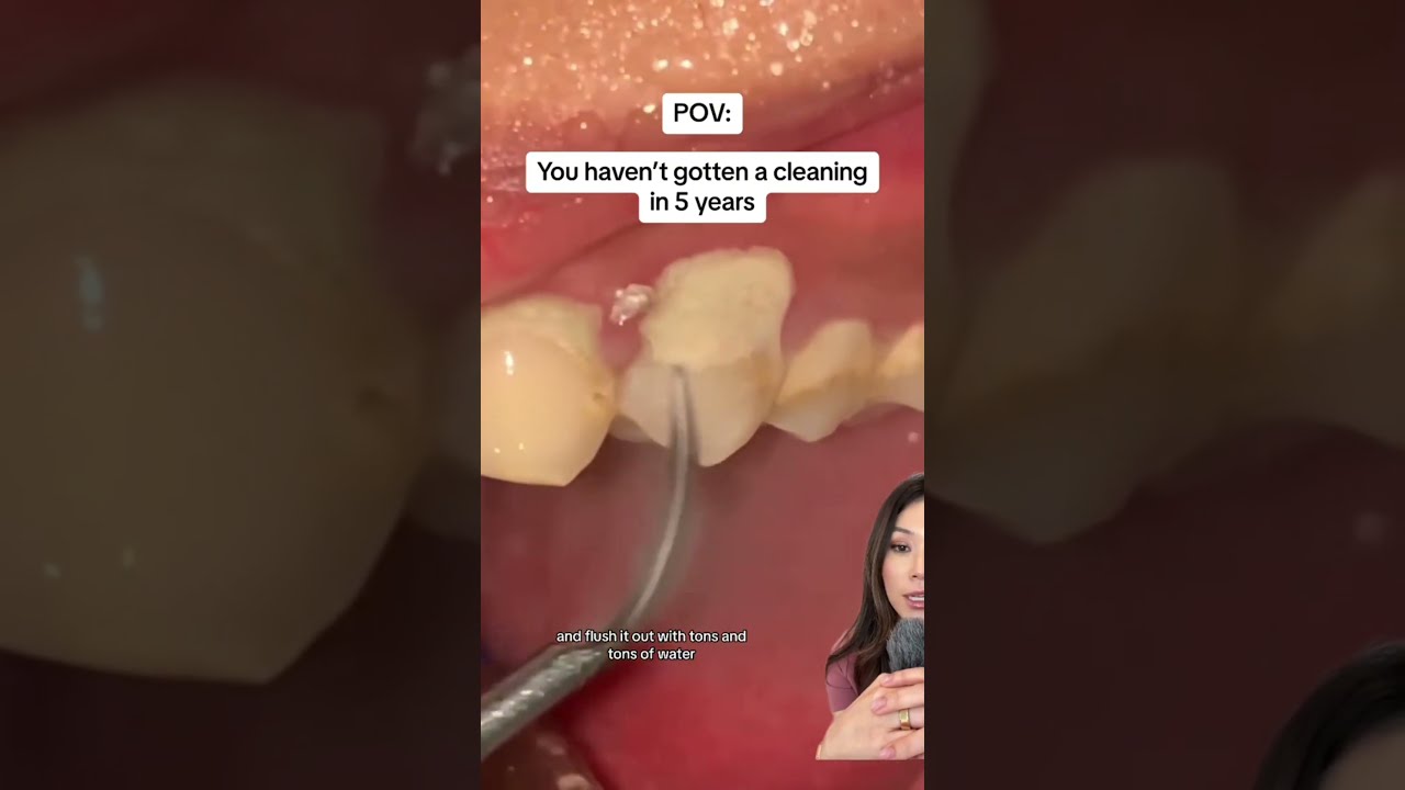 Getting A Teeth Cleaning After 5 Years Teethcleaning Tartarremoval Plaque Tartar