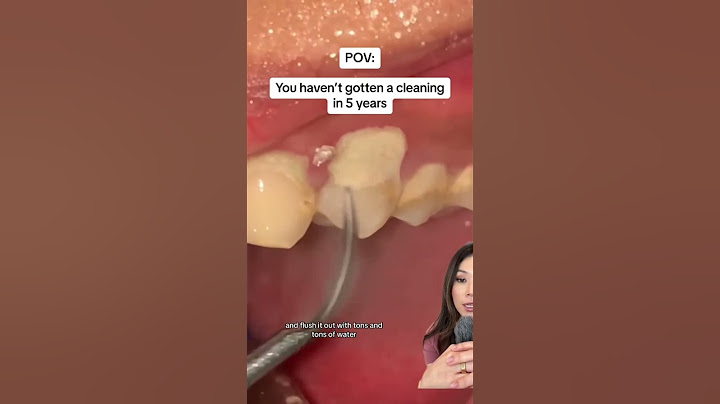 Getting a teeth cleaning after 5 years. #teethcleaning #tartarremoval  #plaque #tartar