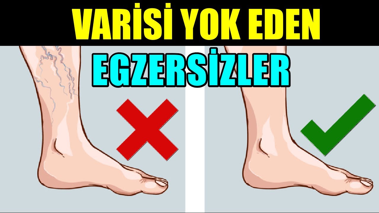 bacaklardaki varisi tedavi eden egzersizler youtube