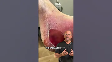 Voted Most Painful Bone Fracture Shorts 