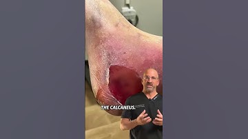 Thumbnail of Voted “Most Painful” Bone Fracture #shorts