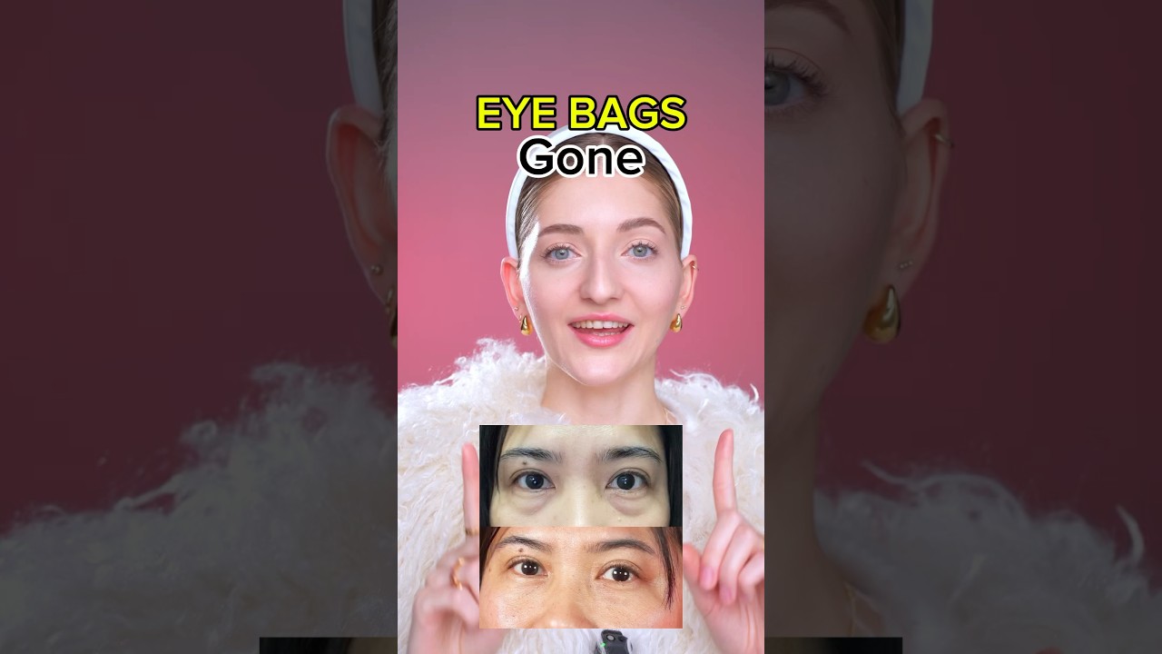 Eye bags gone naturally 