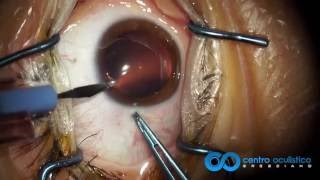 Phakic IOL - ICL Staar Visian Implantation Technique