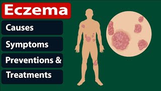 How To Get Ride Of Eczema Home Remedies?