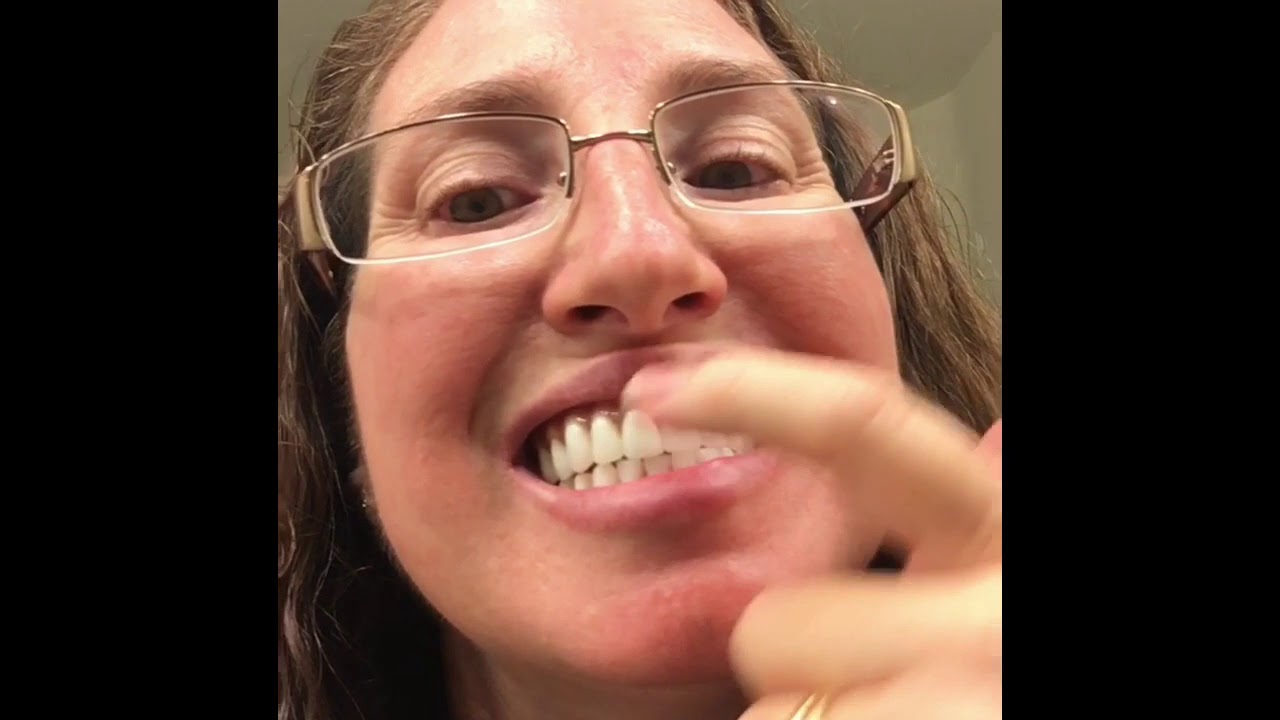 Realist Gum Design on Permanent Dentures- Looks great but....(#58)