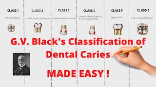 G.V. Black's Classification of Dental Caries (Quick and Complete Revision)