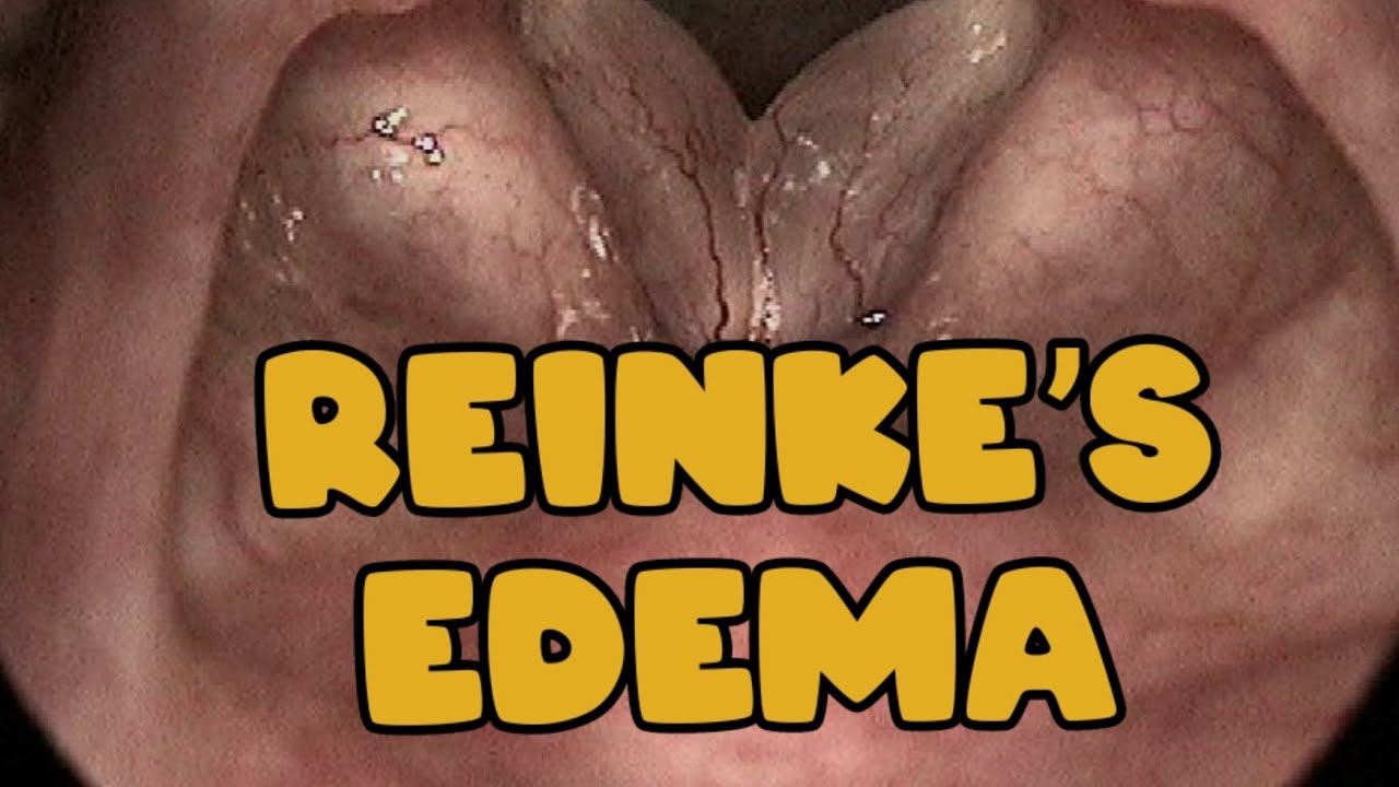 Reinke’s edema Larynx YouTube