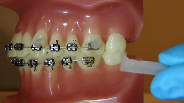 Quanto tenere cera ortodontica?