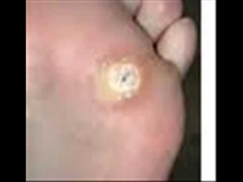 How to Treat Warts on Your Feet: 11 Steps (with Pictures)